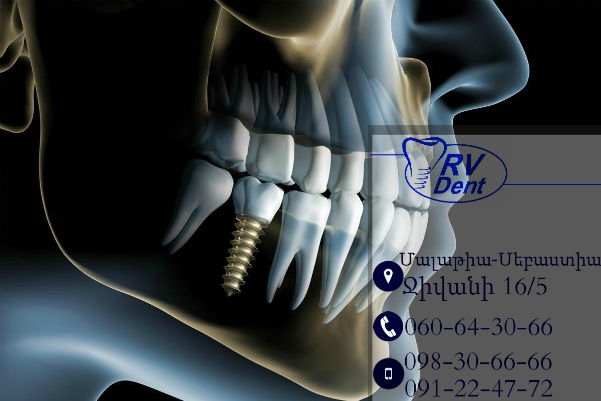 Implantologia Osteintegrata